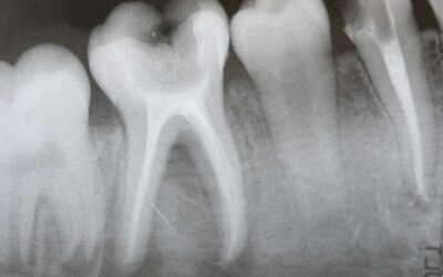 Root canals: The horrible truth revealed (tooth-organ chart)