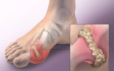 How to remove gout and joint pain from your life – uric acid and crystals
