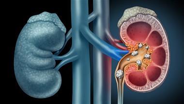 Antibiotics identified as risk factors for kidney stones